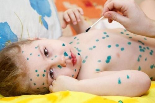Түүхэнд анх удаа цэцэг өвчний эсрэг вакциныг амжилттай хэрэглэжээ