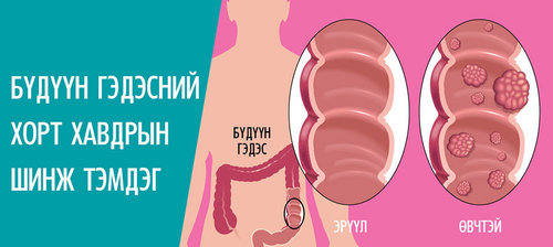 Бүдүүн гэдэсний хавдар: АНУ, Монголд