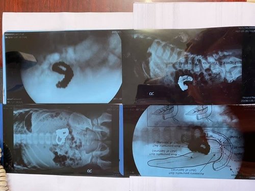 Дөрвөн настай хүүд мэс засал хийж 56 ширхэг соронз гаргаж авчээ